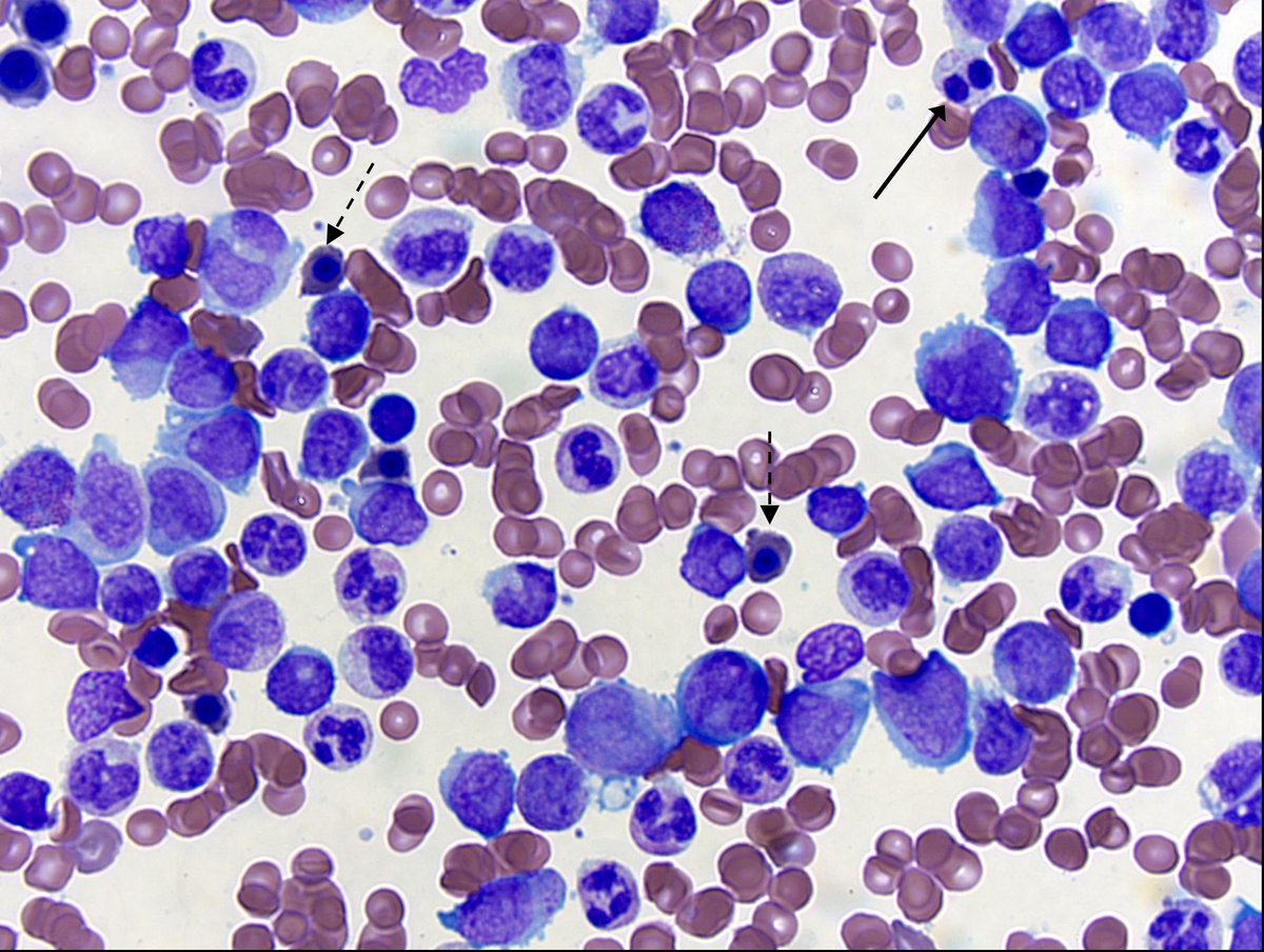 Bone marrow aspirate, Wright-Giemsa; original magnification 500X: Blasts, pseudo Pelgar-Huet cell (solid arrow) and nucleated reticulocytes with irregular nuclear contours (dashed arrows)